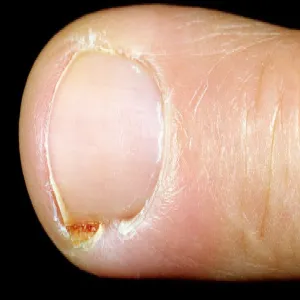 Wrastający paznokieć zdjęcie