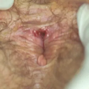 Wrzód weneryczny odbyt