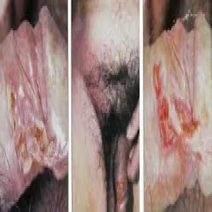 Wrzód-weneryczny zdjęcie