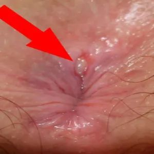 Wstydliwe choroby odbytu szczelina odbytu 