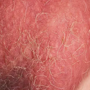 Wszy w miejscach intymnych