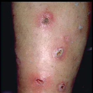 Wykwity pęcherzykowo-krostkowe na podłożu rumieniowym ecthyma 