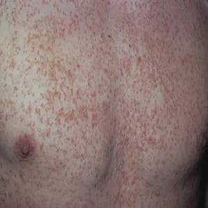 Wykwity skórne na klatce piersiowej choroba Dariera