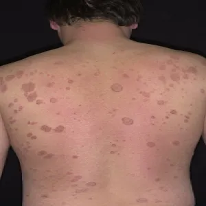 Wyprysk pieniążkowaty na plecach