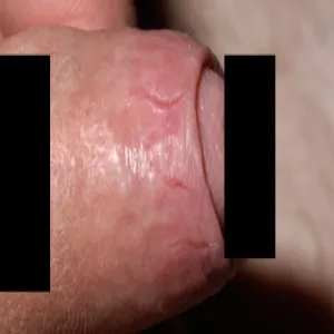 Wyprzenia drożdżakowe zapalenie napletka zdjęcie