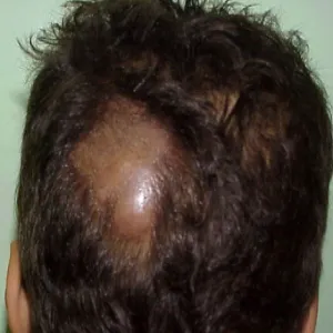 Wypukłe znamiona na skórze głowy