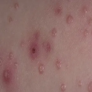 Wysypka czerwone kropki mięczak zakaźny