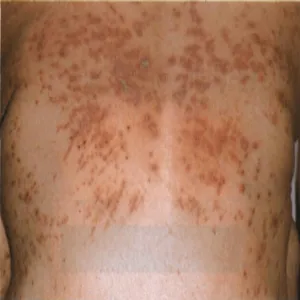 Wysypka grudkowa na plecach choroba Kyrle