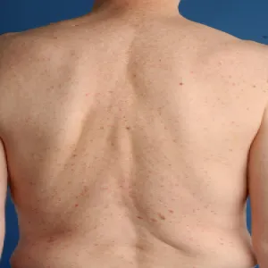 Wysypka jaskrawoczerwonych grudek na skórze pleców choroba Grovena