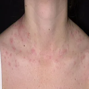 Wysypka klatka piersiowa szyja pokrzywka cholinergiczna 