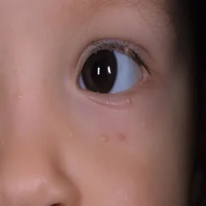 Wysypka koło oka u dziecka
