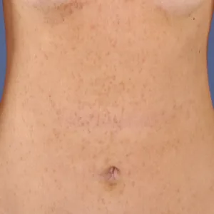 Wysypka na brzuchu choroba Dariera