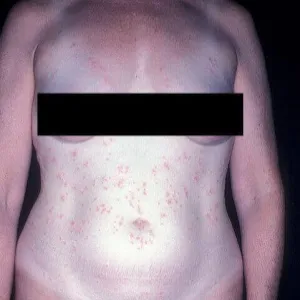 Wysypka na brzuchu i klatce piersiowej zapalenie mieszków włosowych