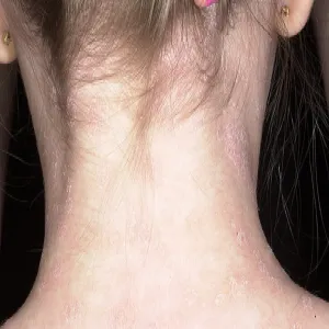 Wysypka na karku łupież Giberta