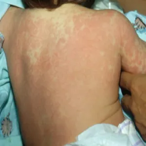 Wysypka na plecach u dziecka choroba Kawasaki