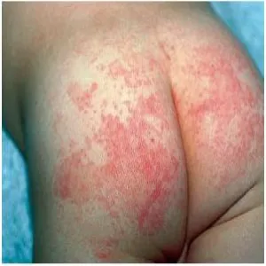 Wysypka na pośladkach rumień zakaźny