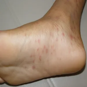 Wysypka na stopach łupież różowy Giberta