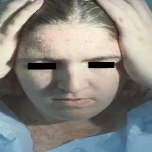 Wysypka na twarzy choroba Dariera