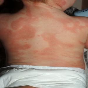 Wysypka pokrzywka alergiczna u dziecka