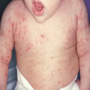 Wysypka u dziecka na skórze choroba świerzb