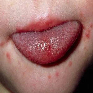 Wysypka wokół ust u dziecka 