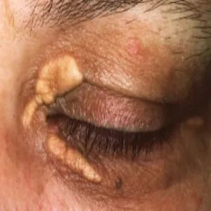 Złogi cholesterolowe pod oczami kępki żółte