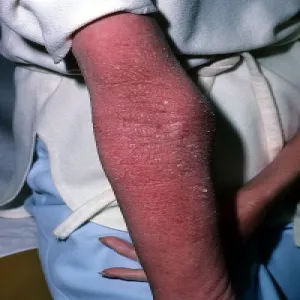 Złuszczające zapalenie skóry 