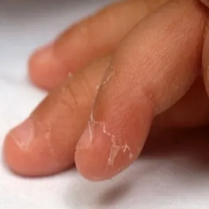  Złuszczanie się skóry choroba Kawasakiego