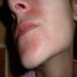 Zaczerwienienie i swędzenie skóry wokół ust