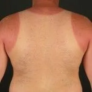 Zaczerwienienie po opalaniu uczulenie