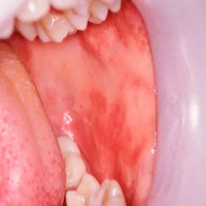 Zaczerwienione gardło u dzieci choroba odra