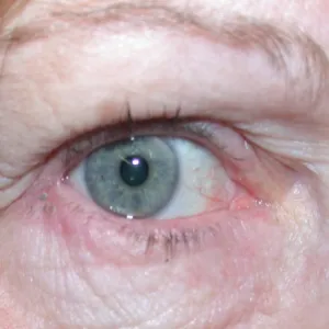 Zaczerwienione powieki zapalenie brzegów powieki 