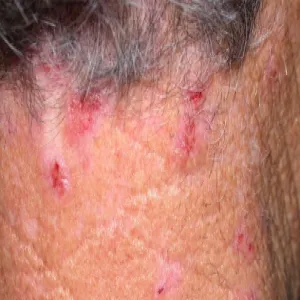 Zadrapania przeczosy na szyi