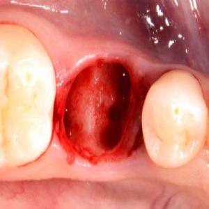 Zakażenie po wyrwaniu zęba objawy