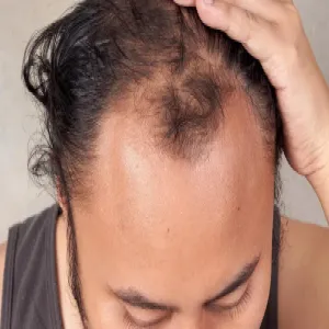 Zakola w młodym wieku łysienie androgenowe 