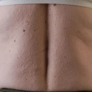 Zanik plamisty skóry forma guzów