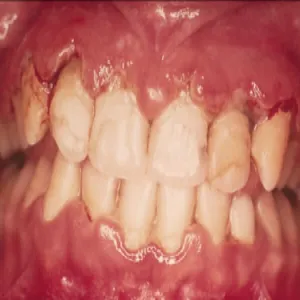 zapalenie dziąseł Vincenta