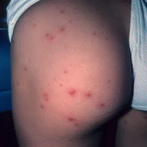 Zapalenie mieszków włosowych na pośladku