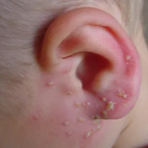 Zapalenie mieszków włosowych na twarzy u dziecka