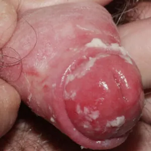 Zapalenie napletka wygląd