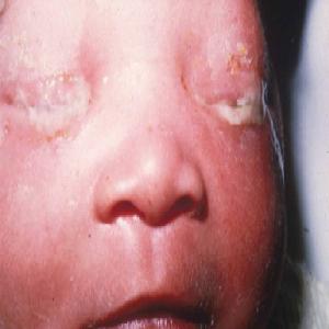 Zapalenie spojówek u noworodków wywołane przez bakterię Chlamydia trachomatis