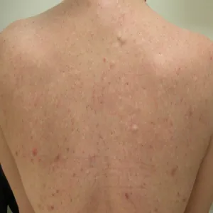 Zaskórniki na plecach od palenia tytoniu