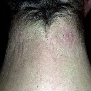 Zaskórniki otwarte na szyi