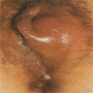 Zdjęcia chorób wenerycznych u kobiet rzeżączka