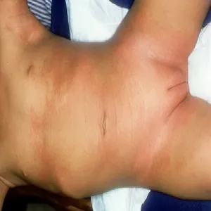 Zespół Kawasakiego