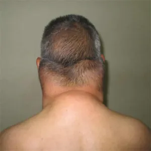 Zespół Launois-Bensaude 