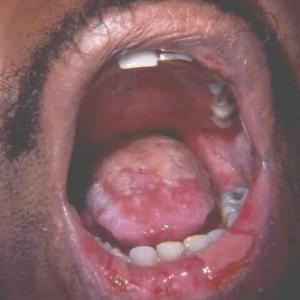 Zespół Stevensa- Johnsona jamy ustnej