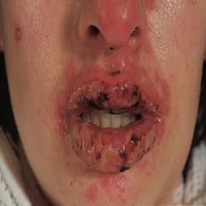 Zespół Stevensa- Johnsona na ustach