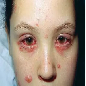 Zespół Stevensa- Johnsona oczy