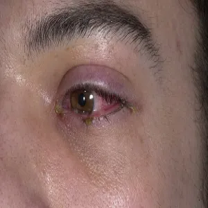 Zespół Stevensa- Johnsona oka